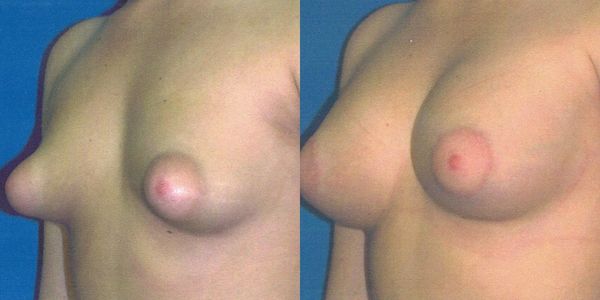 Breast Augmentation Before and After Patient 18