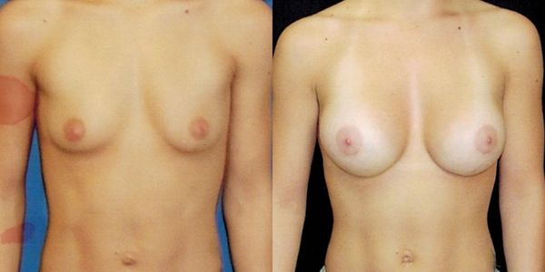 Breast Augmentation Before and After Patient 188