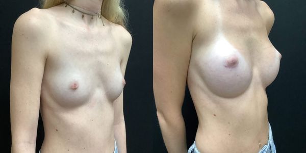 Breast Augmentation Before and After Patient 190 3