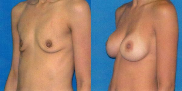 Breast Augmentation Before and After Patient 33 2