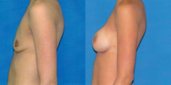 Breast Augmentation Before and After Patient 33