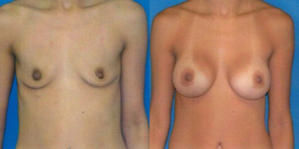 Breast Augmentation Before and After Patient 33 3