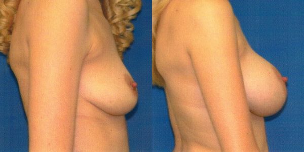 Breast Augmentation Before and After Patient 34