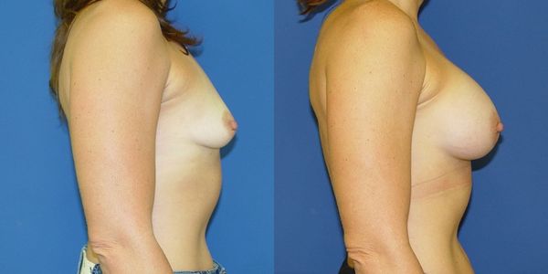 Breast Augmentation Before and After Patient 36