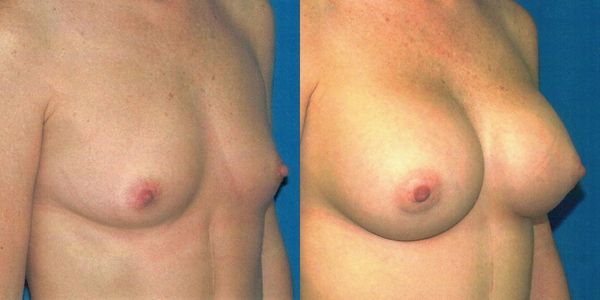 Breast Augmentation Before and After Patient 38 2