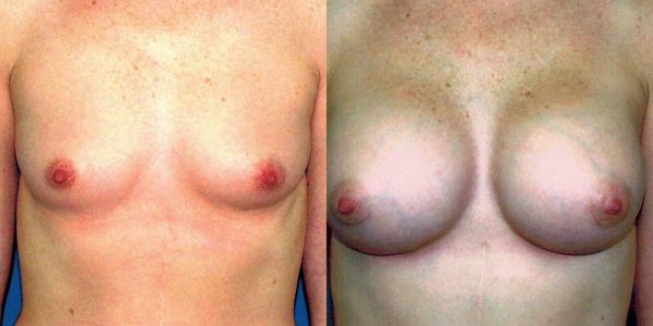 Breast Augmentation Before and After Patient 38