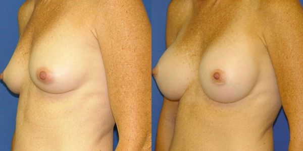 Breast Augmentation Before and After Patient 40