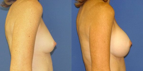 Breast Augmentation Before and After Patient 40 3