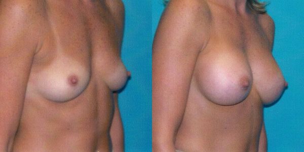 Breast Augmentation Before and After Patient 42 6