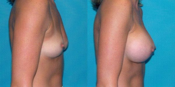 Breast Augmentation Before and After Patient 42 5