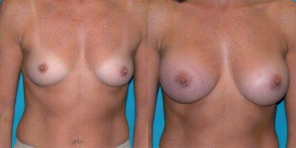 Breast Augmentation Before and After Patient 42 7