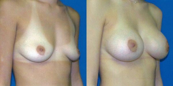 Breast Augmentation Before and After Patient 43 2