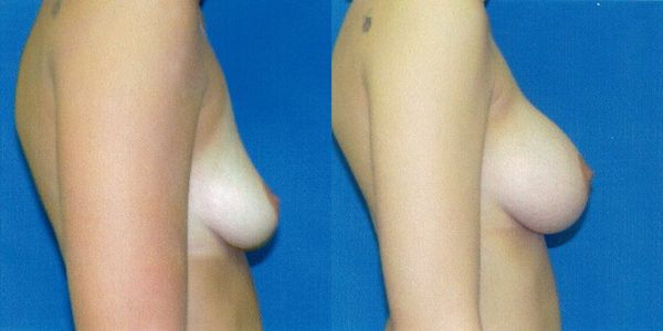 Breast Augmentation Before and After Patient 43