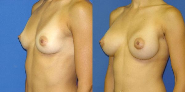 Breast Augmentation Before and After Patient 44 5