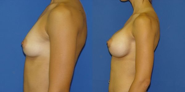 Breast Augmentation Before and After Patient 44 4