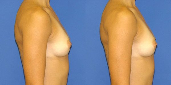 Breast Augmentation Before and After Patient 44 2