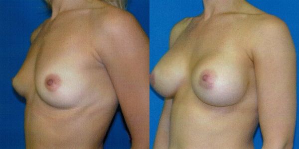 Breast Augmentation Before and After Patient 45 5