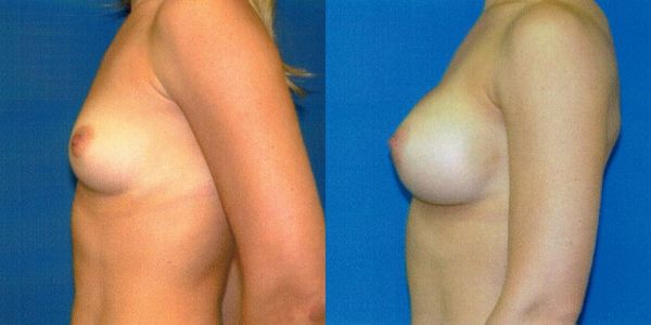 Breast Augmentation Before and After Patient 45 4