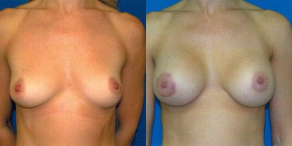 Breast Augmentation Before and After Patient 45 2