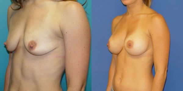 Breast Augmentation Before and After Patient 45