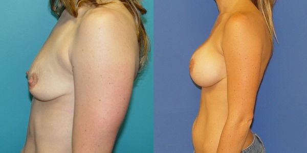 Breast Augmentation Before and After Patient 46 2