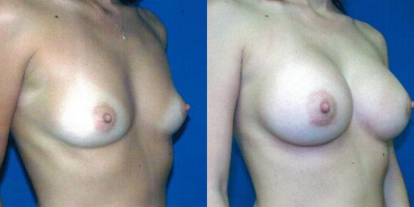 Breast Augmentation Before and After Patient 48