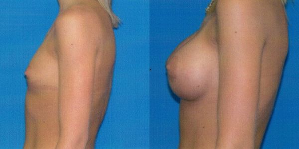 Breast Augmentation Before and After Patient 49
