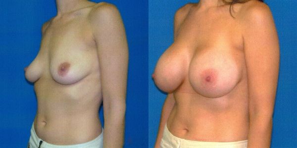 Breast Augmentation Before and After Patient 50 2