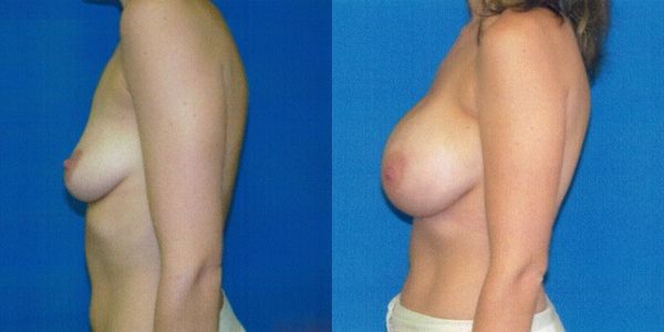 Breast Augmentation Before and After Patient 50