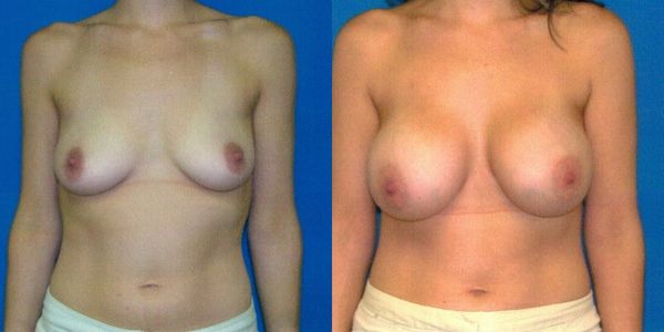 Breast Augmentation Before and After Patient 50 3