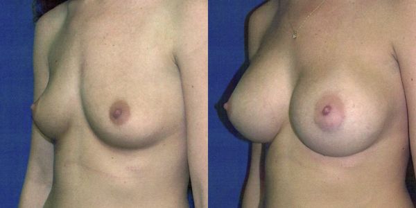 Breast Augmentation Before and After Patient 51