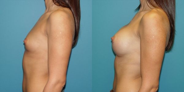 Breast Augmentation Before and After Patient 52 5