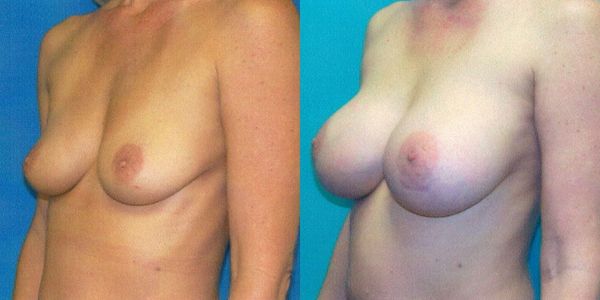 Breast Augmentation Before and After Patient 53 2