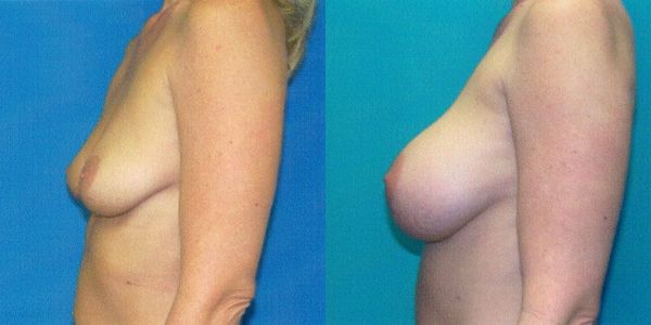 Breast Augmentation Before and After Patient 53