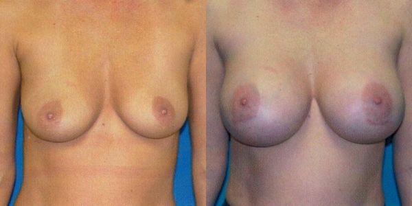 Breast Augmentation Before and After Patient 53 7