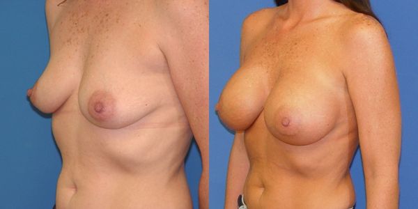 Breast Augmentation Before and After Patient 54