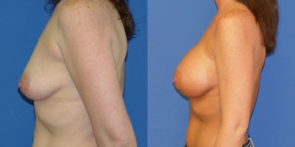 Breast Augmentation Before and After Patient 54 5