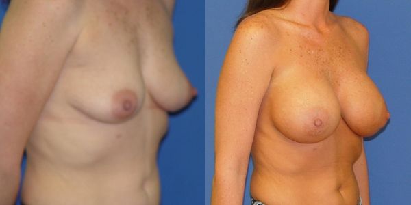 Breast Augmentation Before and After Patient 54 4