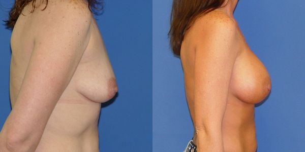 Breast Augmentation Before and After Patient 54 3