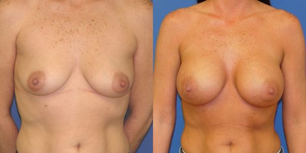Breast Augmentation Before and After Patient 54 2