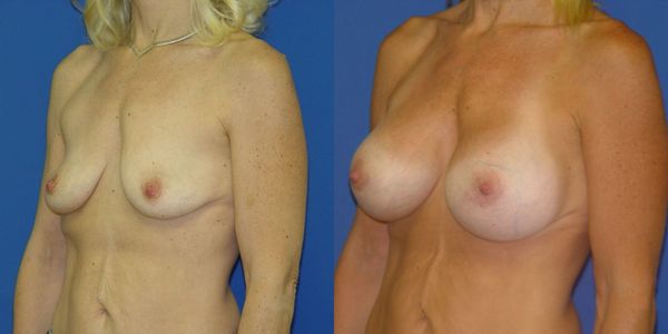 Breast Augmentation Before and After Patient 55 2