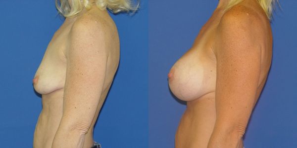 Breast Augmentation Before and After Patient 55