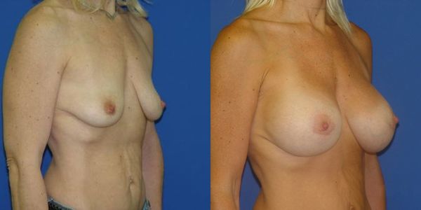 Breast Augmentation Before and After Patient 55 6