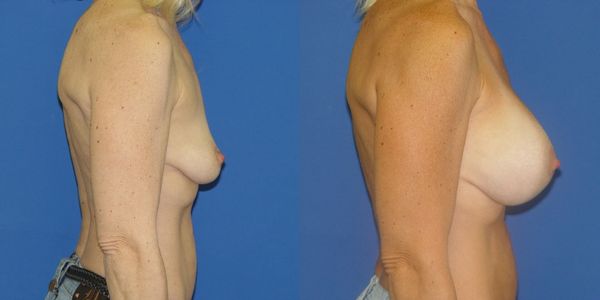 Breast Augmentation Before and After Patient 55 5