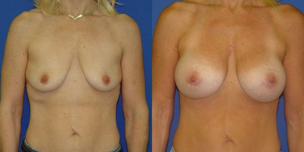 Breast Augmentation Before and After Patient 55 3