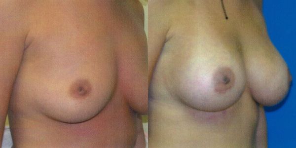 Breast Augmentation Before and After Patient 58 2