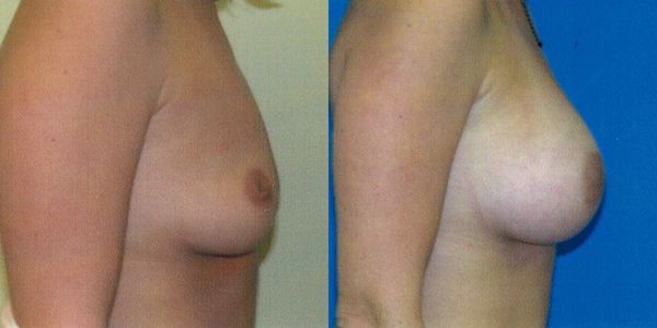 Breast Augmentation Before and After Patient 58