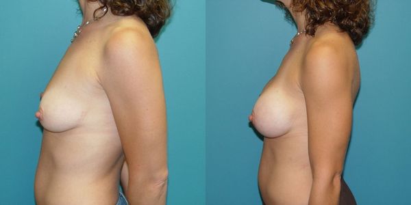 Breast Augmentation Before and After Patient 59 4