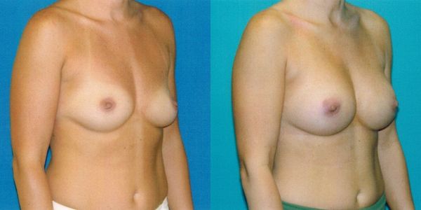 Breast Augmentation Before and After Patient 61 2
