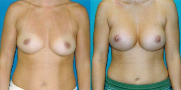 Breast Augmentation Before and After Patient 61